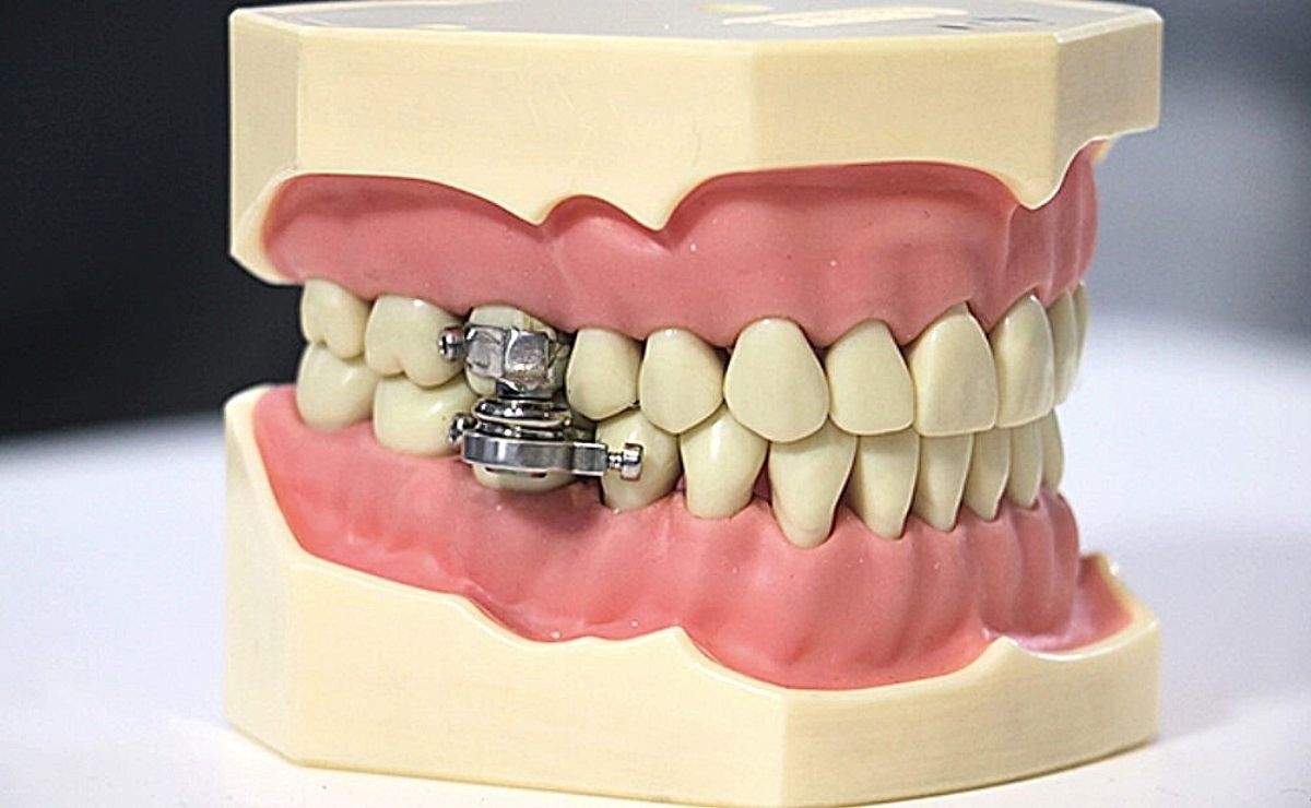 Create A Padlock To Close The Teeth And Lose Weight