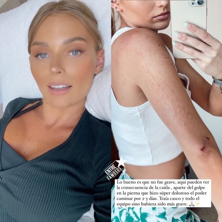 Irina Baeva shows her wounds. Photo: Instagram